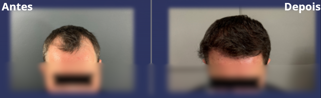 Antes e Depois