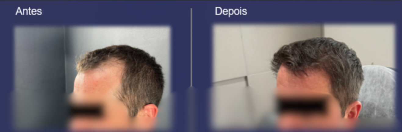 Antes e Depois