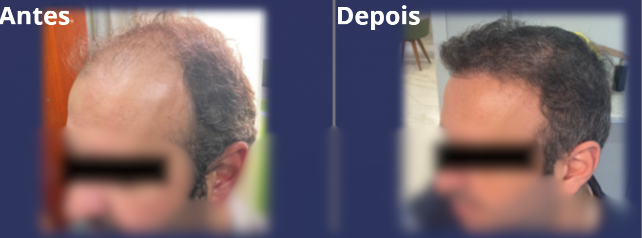Antes e Depois