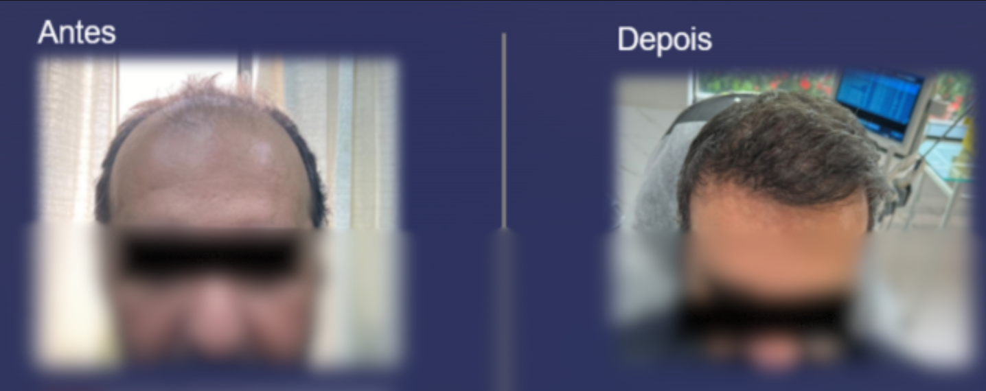 Antes e Depois