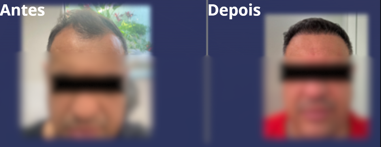 Antes e Depois