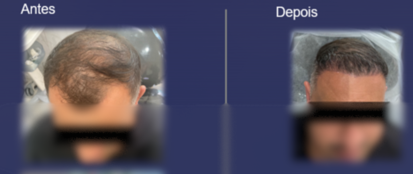 Antes e Depois