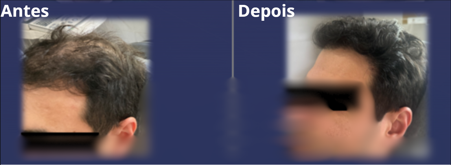 Antes e Depois