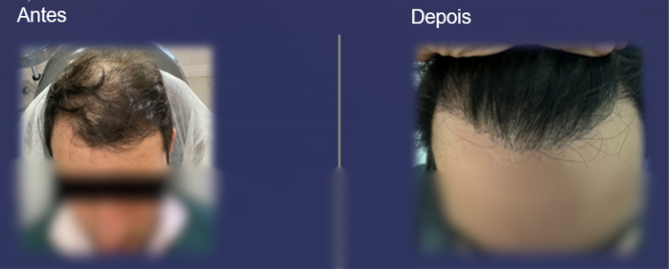 Antes e Depois